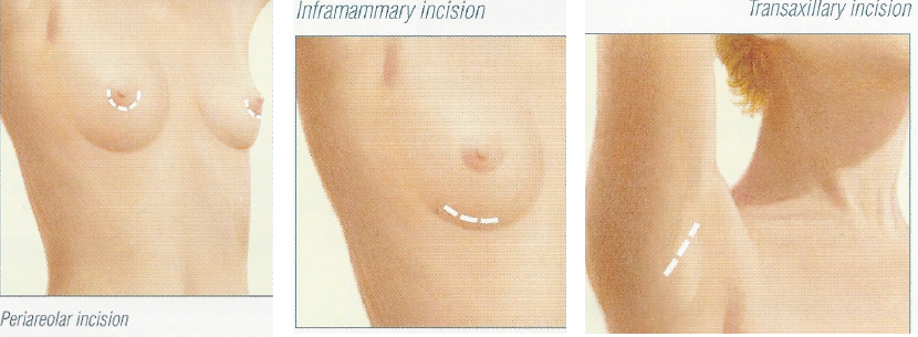 placementof-of-incisions
