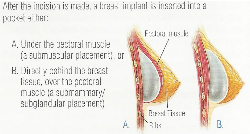 position-of-implants