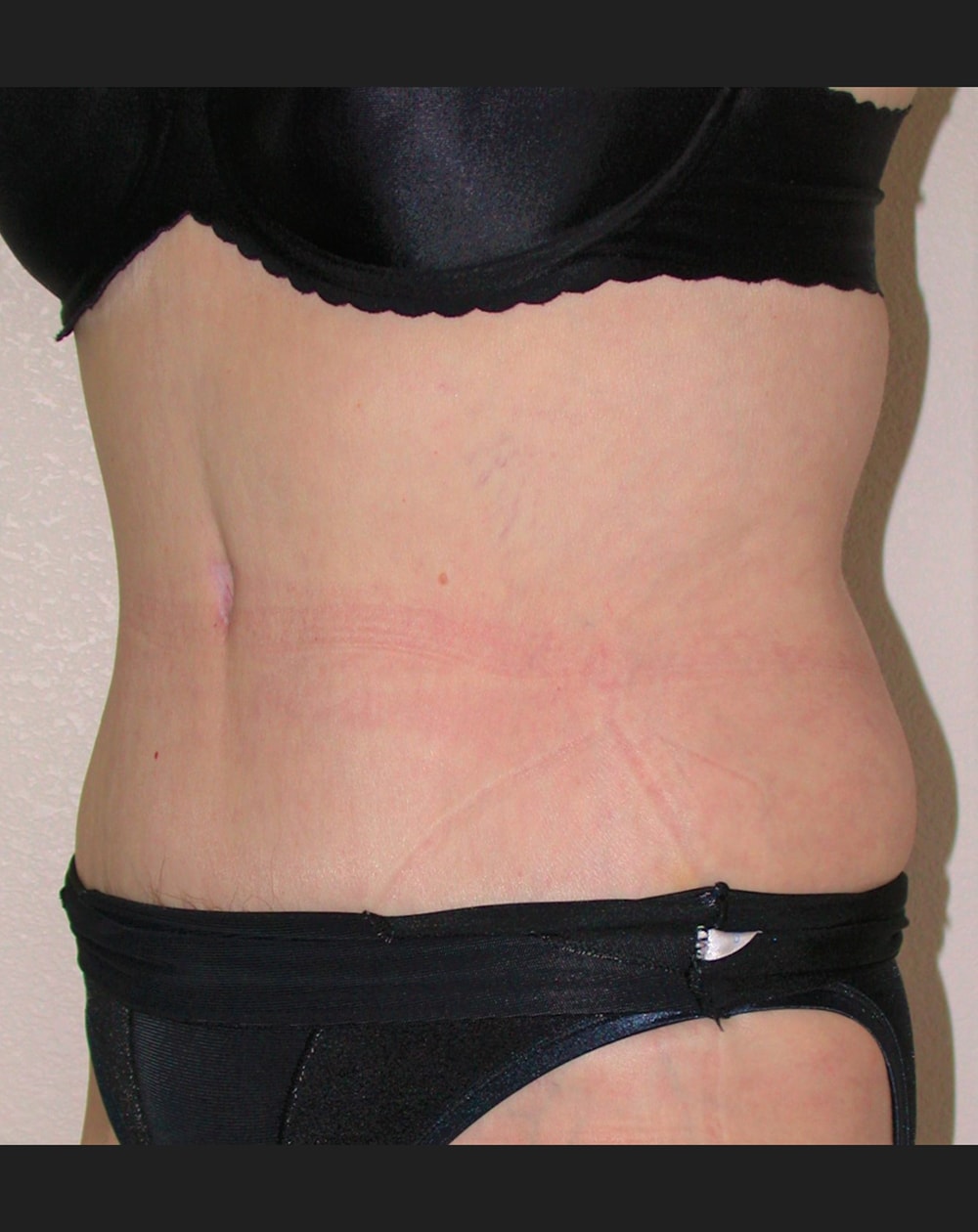 Patient E Body Builder - 6 month Post-Operative Tummy Tuck Lateral